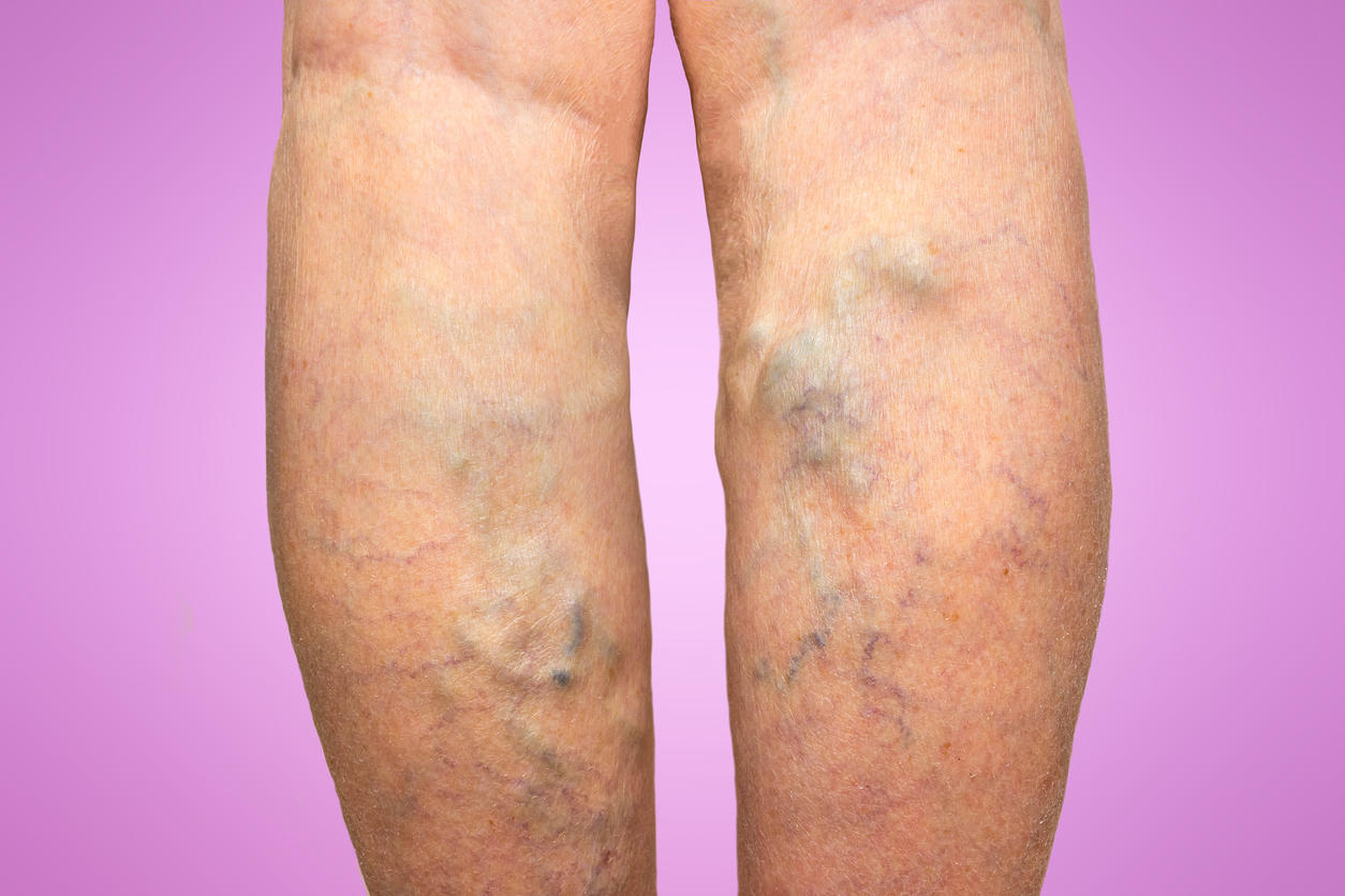 Quels sont les symptômes de la mauvaise circulation sanguine ?