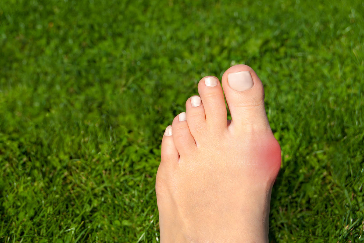 Qu’est-ce que l’Hallux Valgus ?