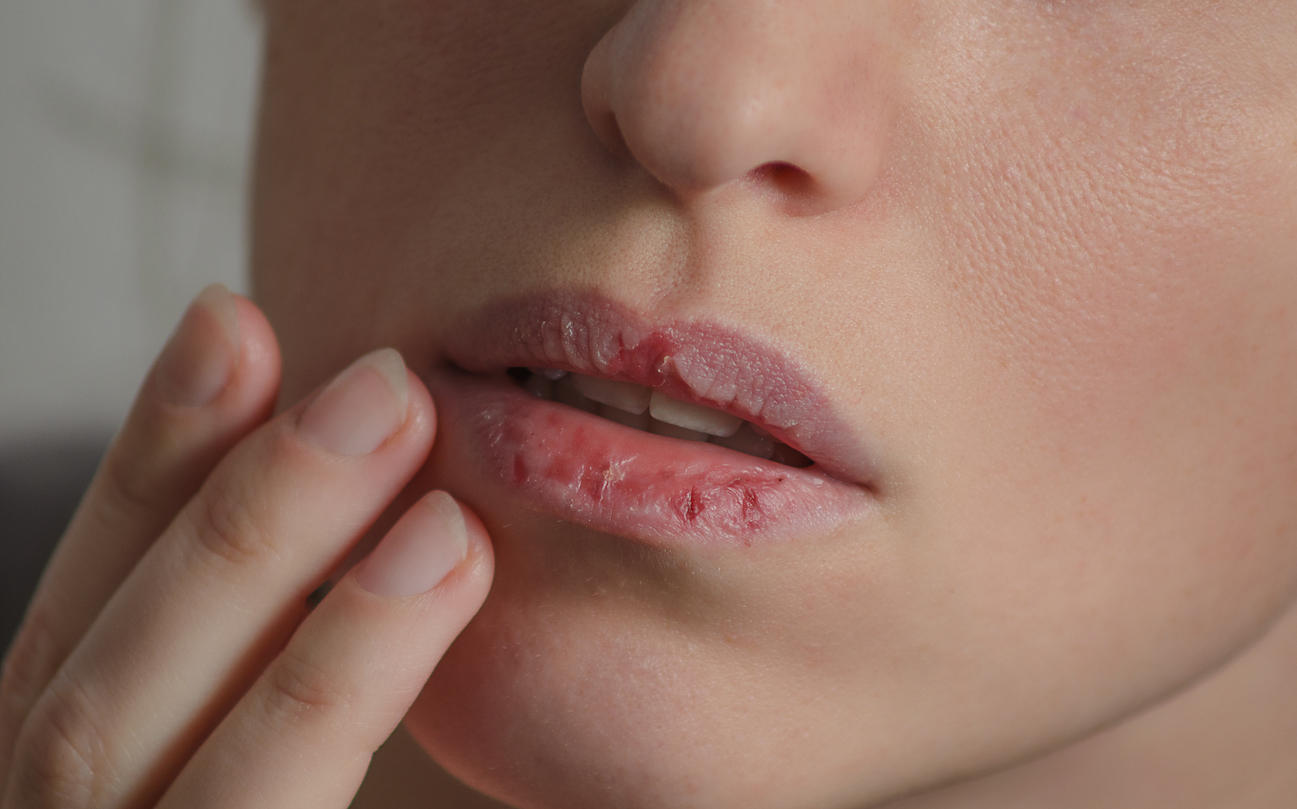 dermatillomania skin picking woman has bad habit to pick her lips harmful addiction based on anxiety stress and dry lips ...