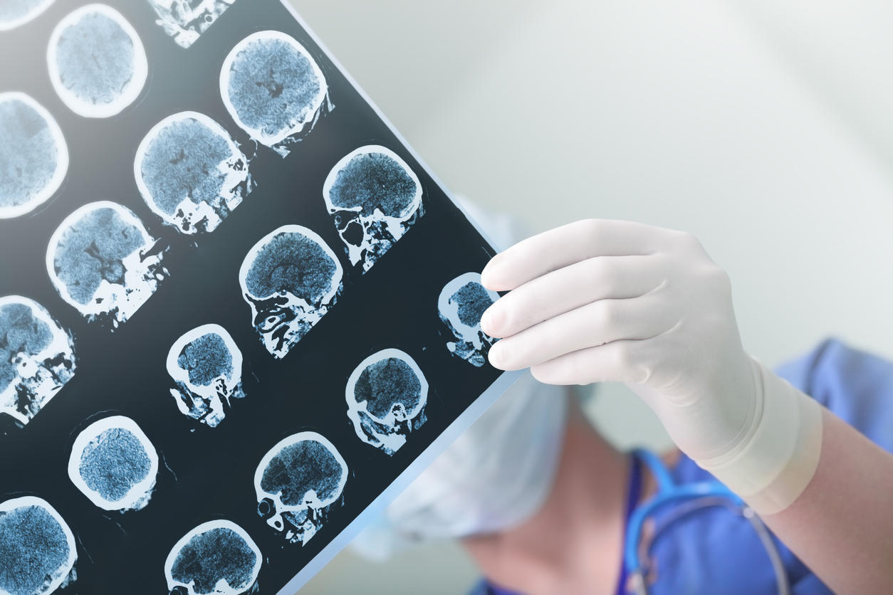 Diagnostic de l'épilepsie