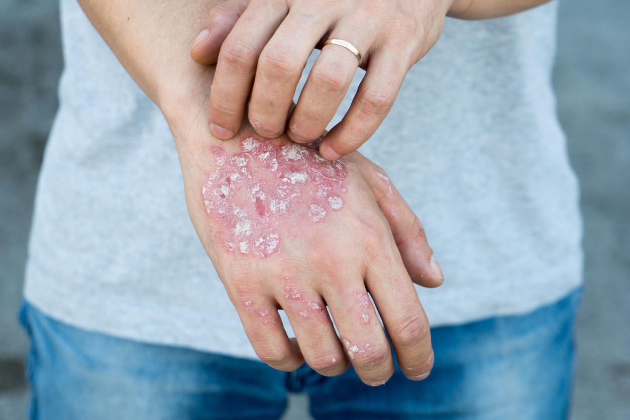 Le Psoriasis palmo-plantaire (mains et pieds)