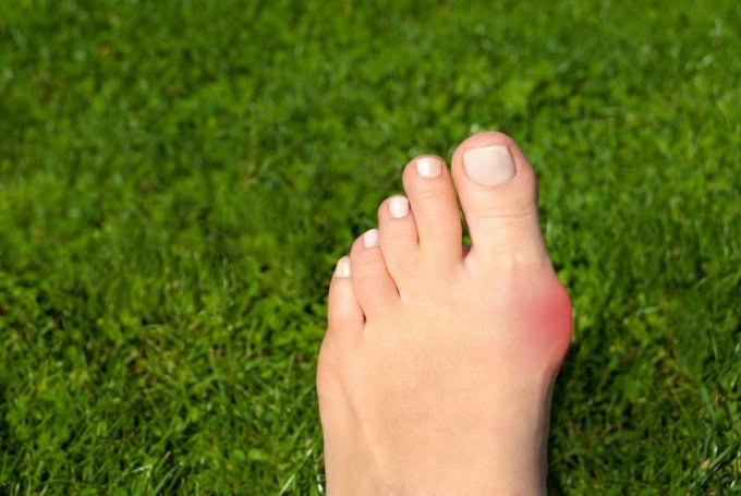 Photo : un cas d'hallux valgus