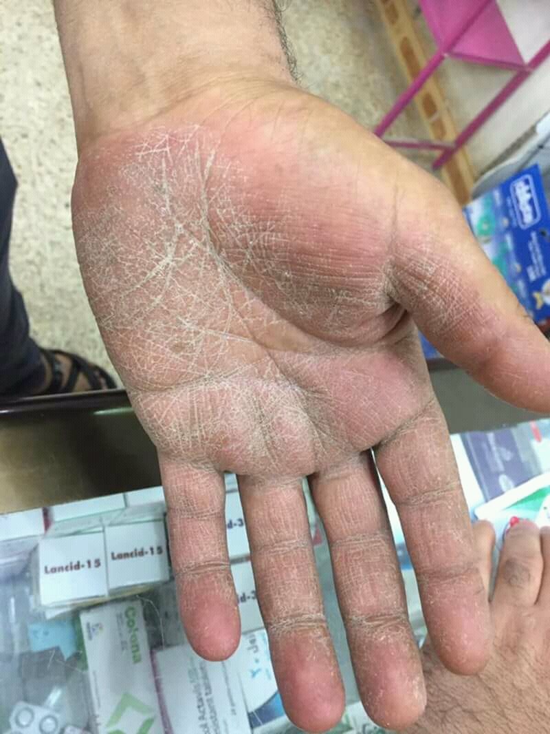 La mycose des mains