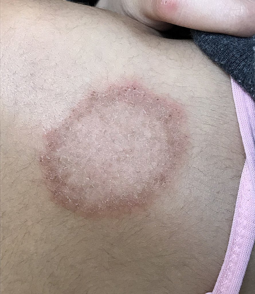 Les mycoses cutanées des plis (fesses, aisselle...)