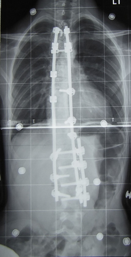 Opération : la chirurgie de la scoliose