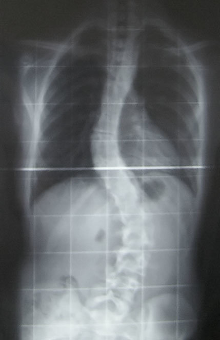 Traitement chirurgical de la scoliose
