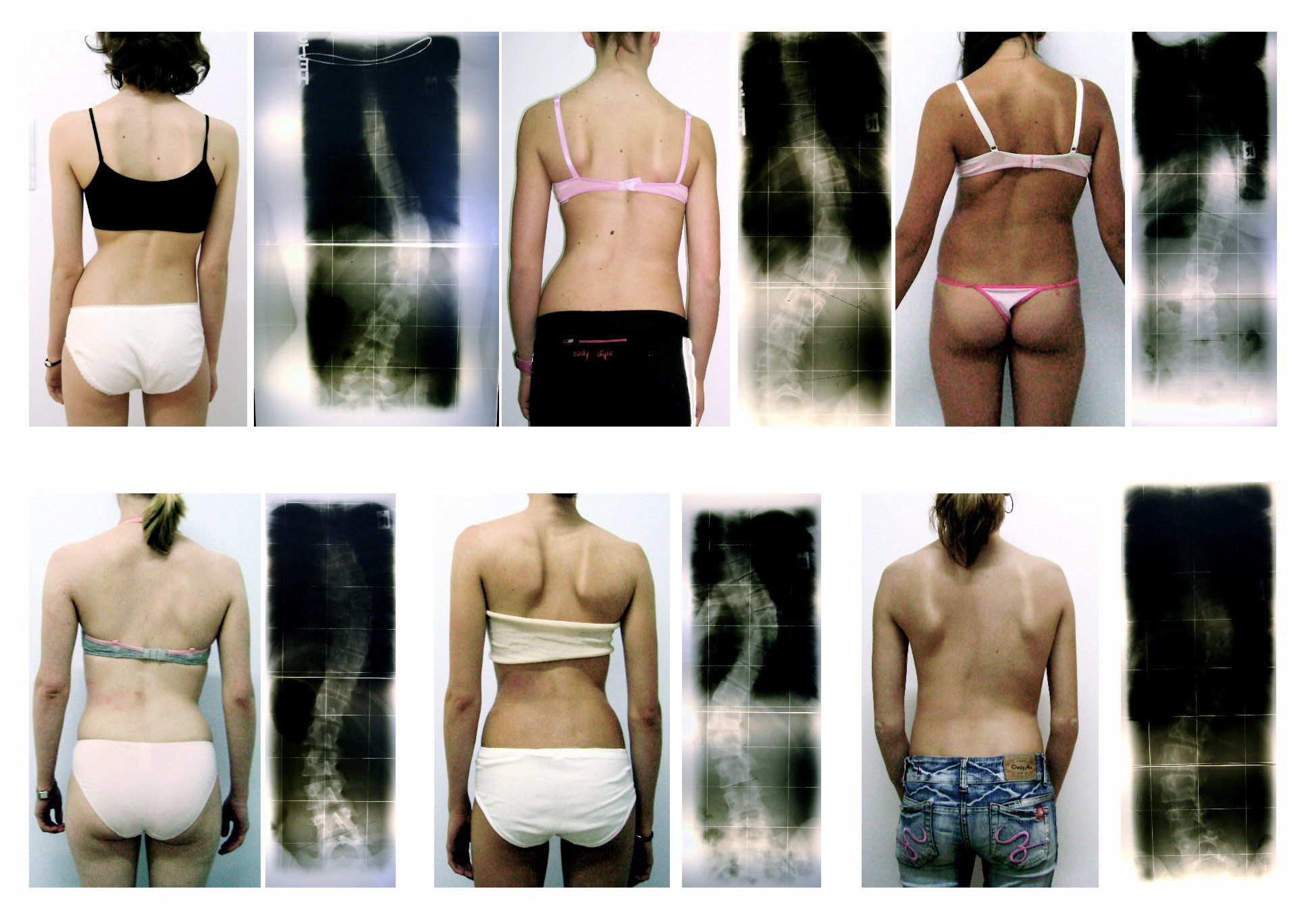 Quelle est l’évolution de cette pathologie ?