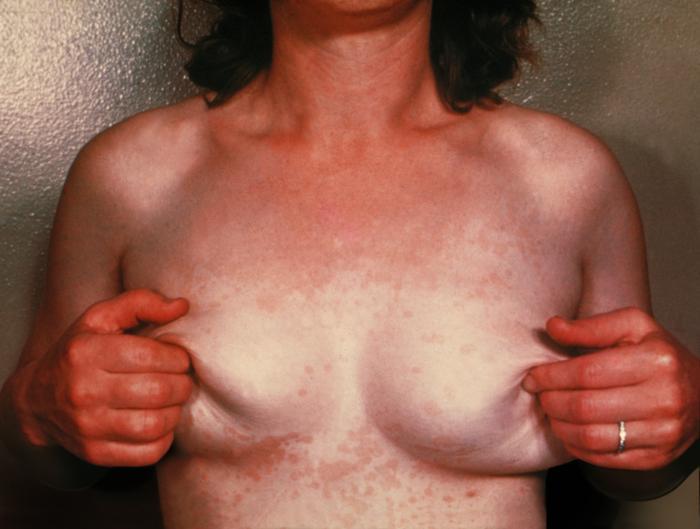 Quels sont les symptômes du pityriasis versicolor ?