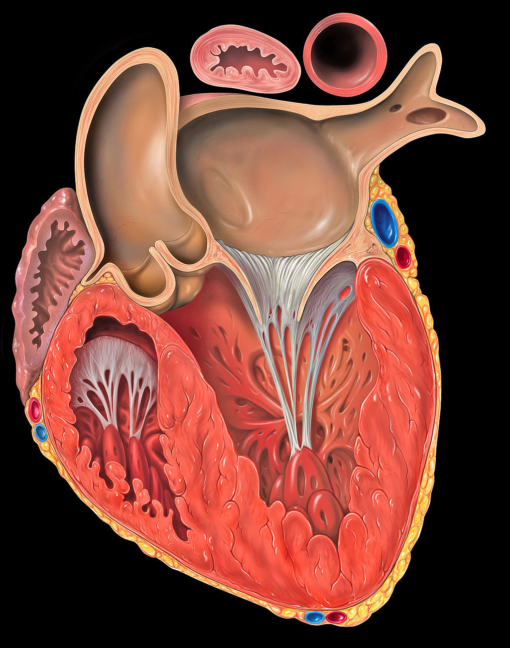Qu'est-ce que l'infarctus du myocarde?