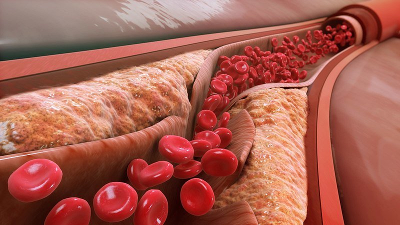 Qu’est-ce qu’une artériopathie oblitérante des membres inférieurs ?