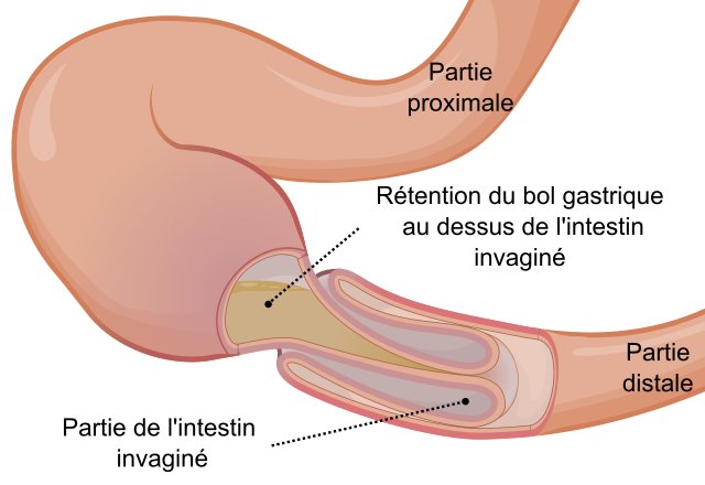 Qu’est-ce que l'invagination intestinale aiguë ?