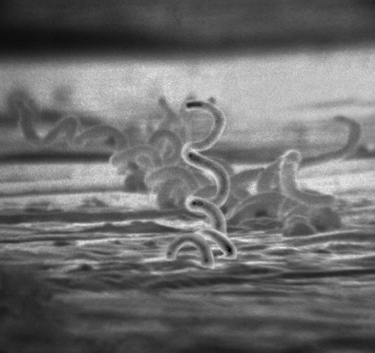 Définition : qu'est-ce que la Syphilis ?