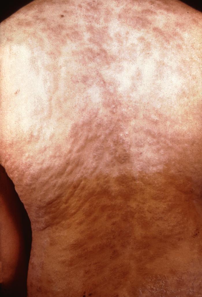 Syphilis secondaire : 6 semaines à 6 mois après l’exposition