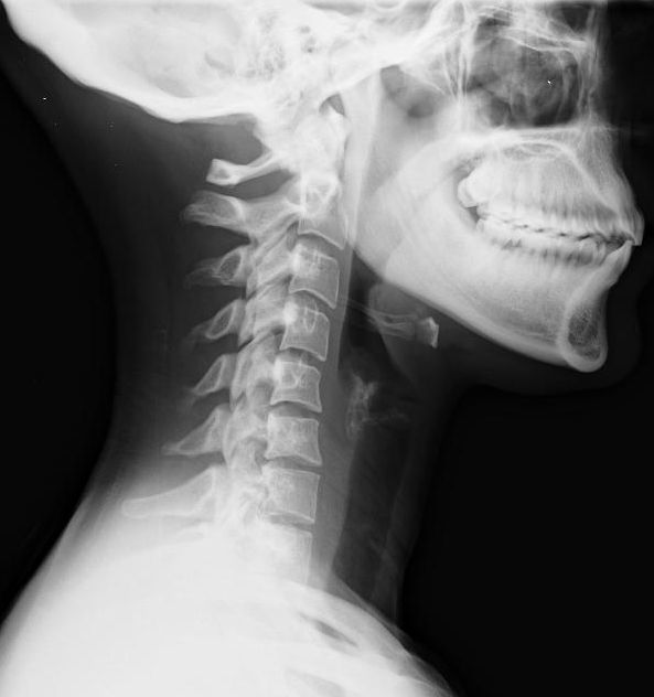 Quels sont les examens et analyses pratiqués en cas de traumatisme cervical ? 