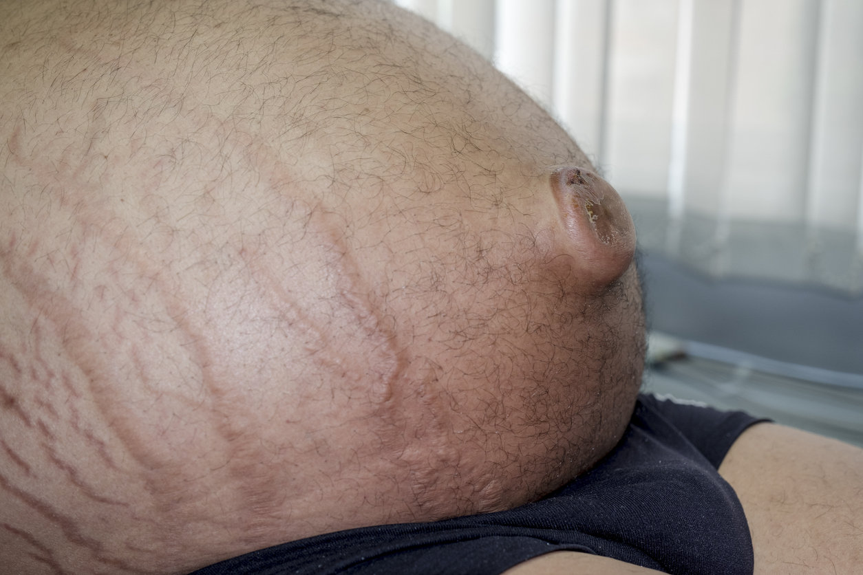 Quels sont les types d’hernies abdominales ?