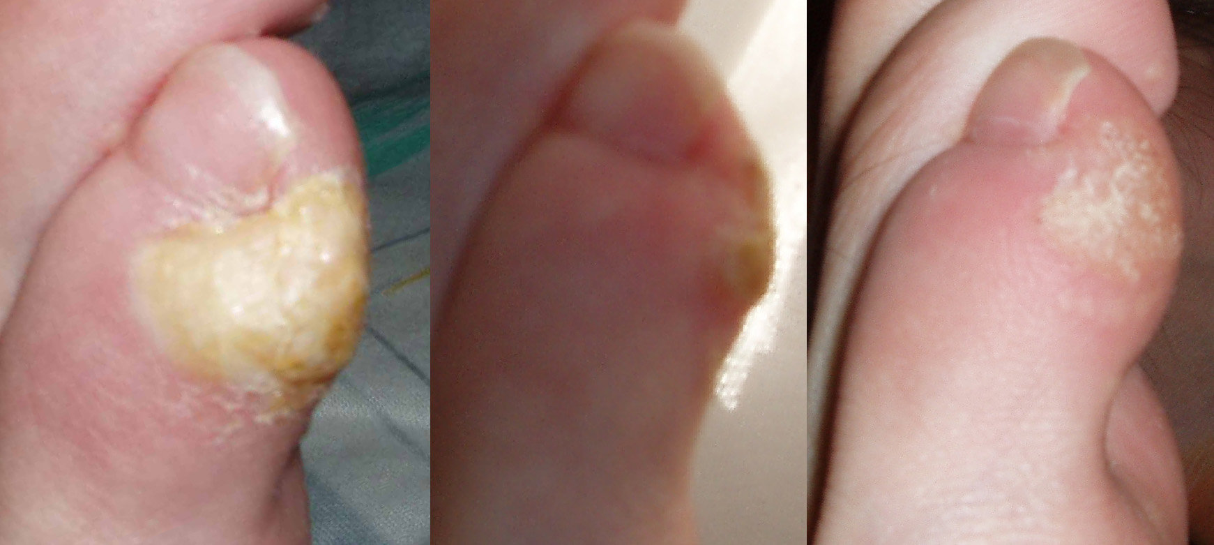 Cors, hallux valgus, verrues : comment faire la différence ?