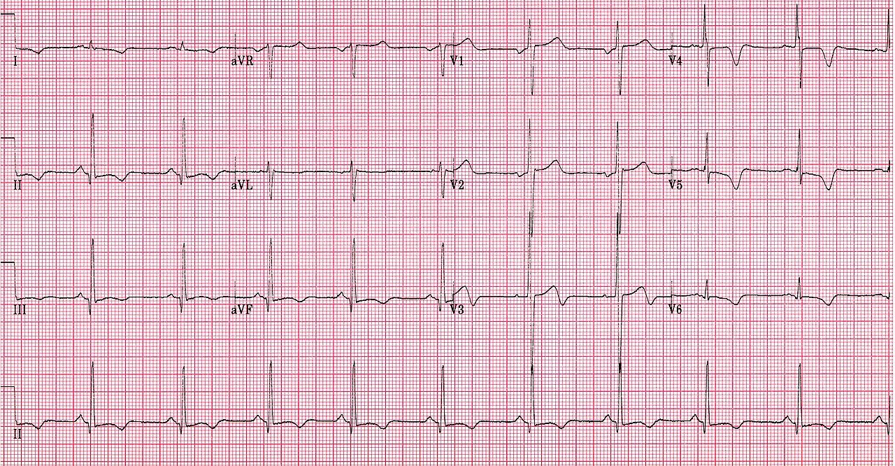 La syncope cardiaque :