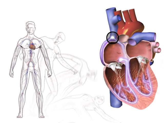 Quelles sont les complications possibles de la syncope ? 