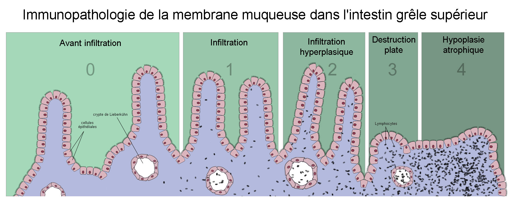 Qu'est-ce que la maladie cœliaque ?