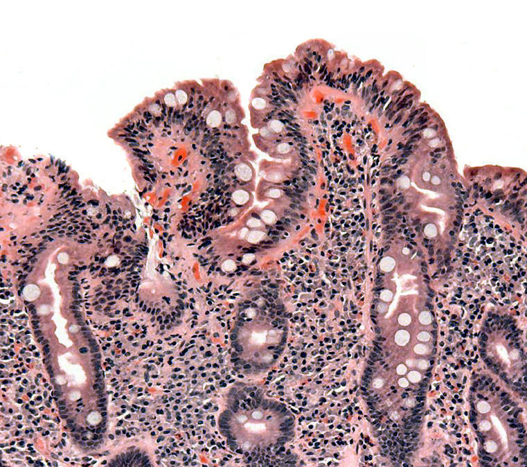 Examens et analyses : comment diagnostiquer la maladie cœliaque ? 
