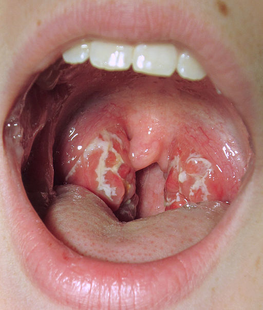 Angines blanches ou rouges ?