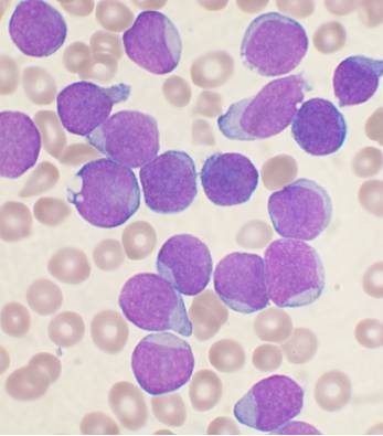 Qu'est-ce que la leucémie lymphoïde chronique (LLC) ?