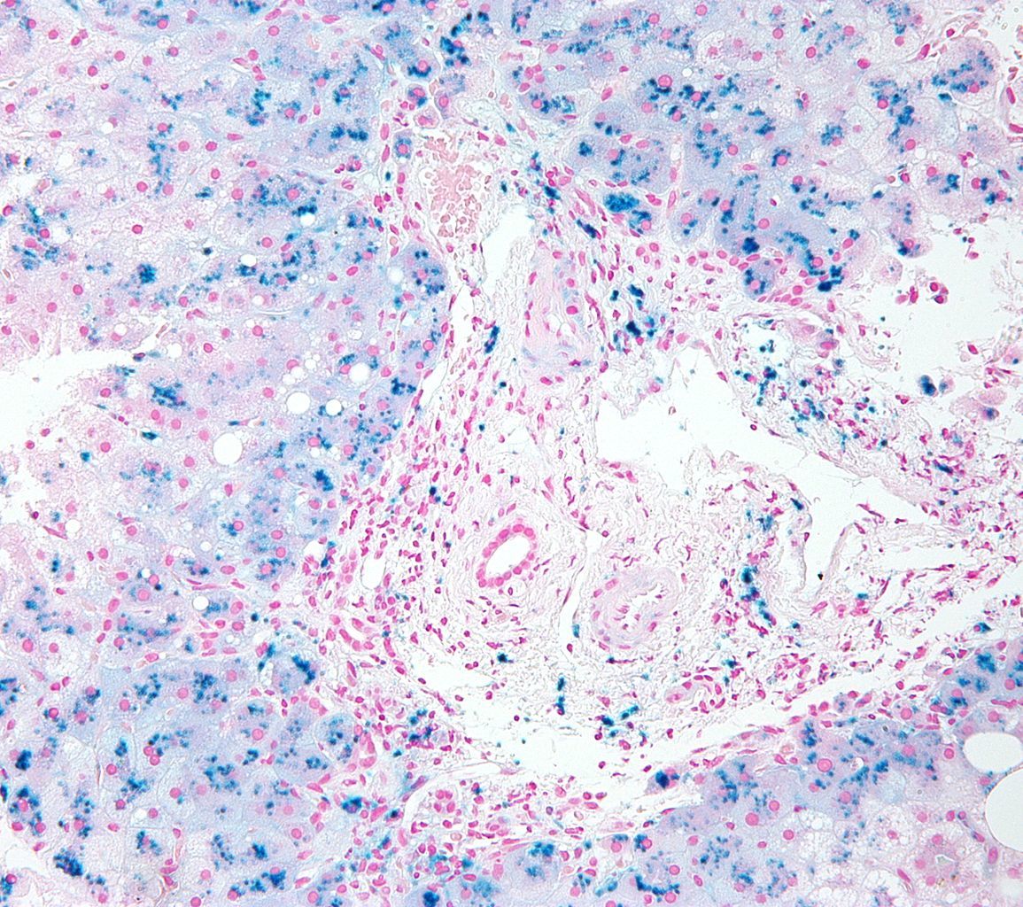 Quelles sont les causes de l'hémochromatose ?