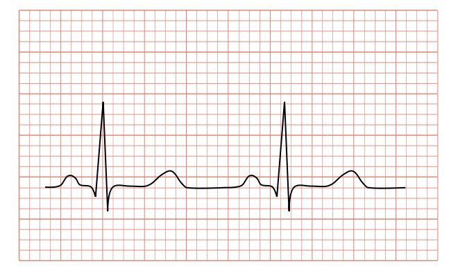 De l'électrocardiogramme ou ECG :