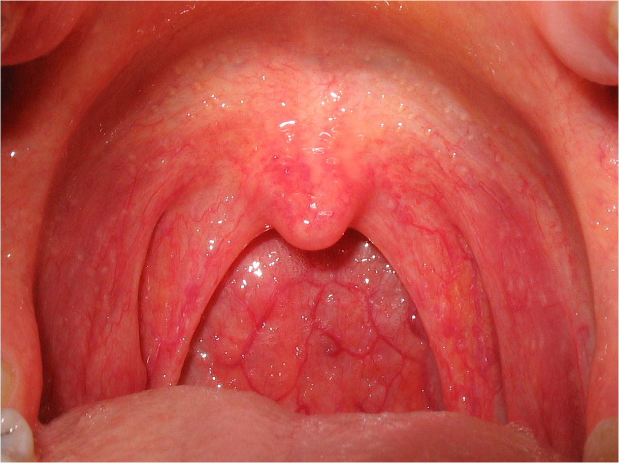 Les complications et l'évolution de la rhinopharyngite