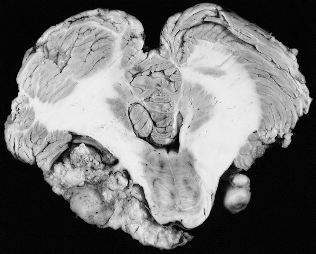 Quelles sont les causes du neurinome de l’acoustique ?
