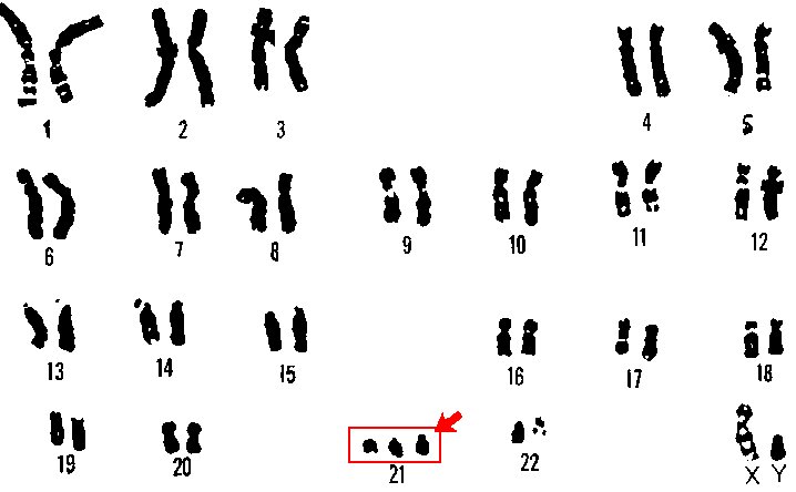 Illustration : caryotype (arrangement standard des chromosomes d'une cellule) d'un garçon trisomique.