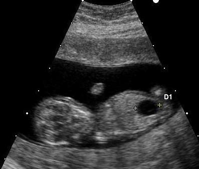 Quelles sont les malformations liées à la trisomie 21 ?