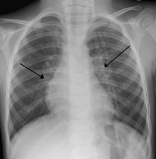 Définition : qu'est-ce que la bronchiolite ?