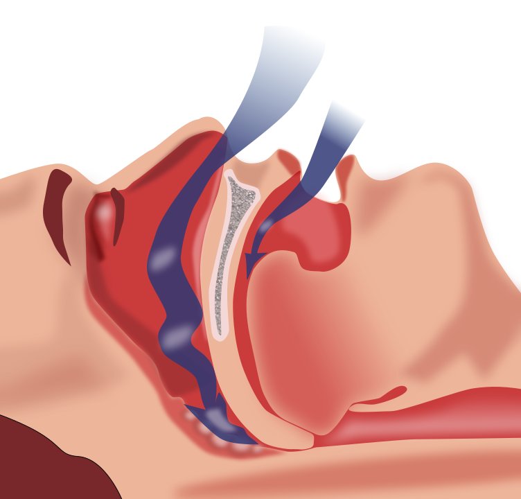 Apnée du sommeil : une cause d'hypertension chez les enfants ?