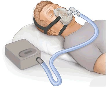 Apnée du sommeil : le traitement par PPC pourrait vous éviter Alzheimer