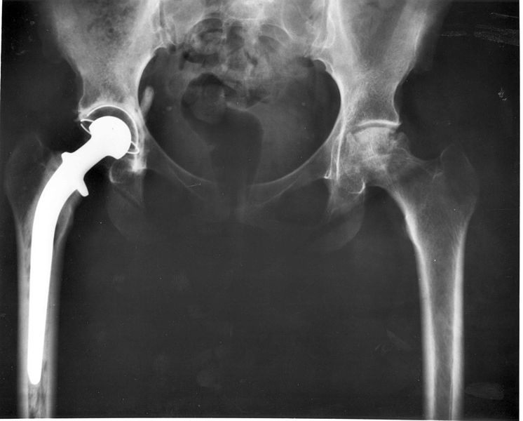 Quelles sont les complications de l'arthrose ?