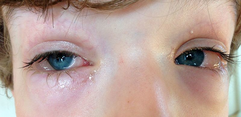 Les symptômes de la conjonctivite allergique