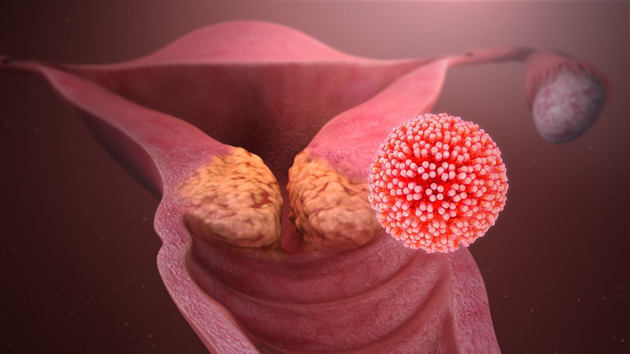Quelles sont les causes du condylome ?