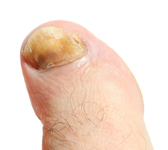 Les symptômes de la mycose des ongles