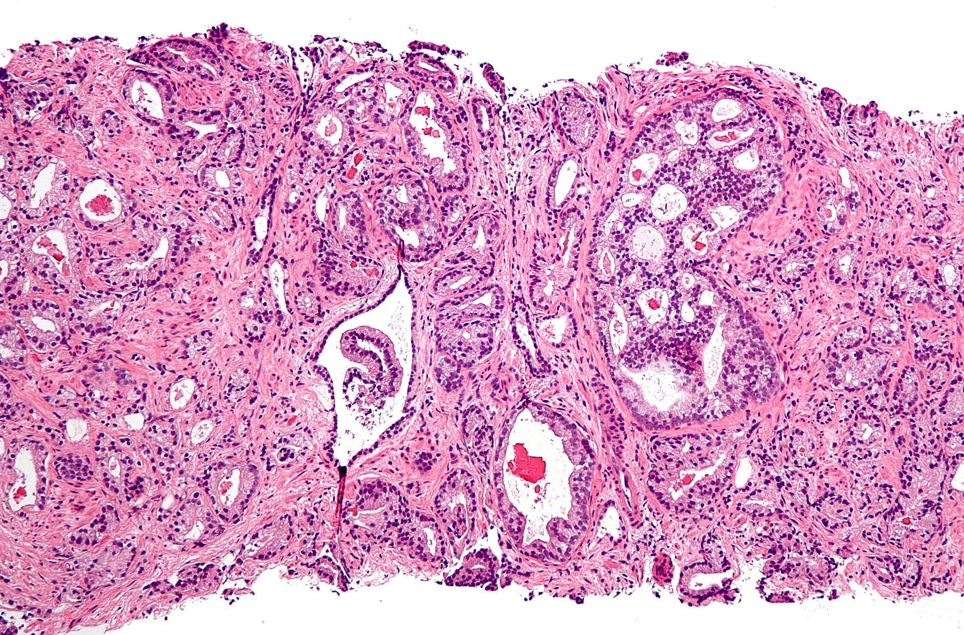 Qu'est-ce que le cancer de la prostate ?