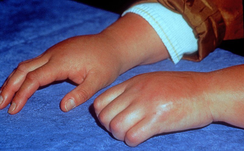 Définition : Qu’est-ce que l’algodystrophie ?