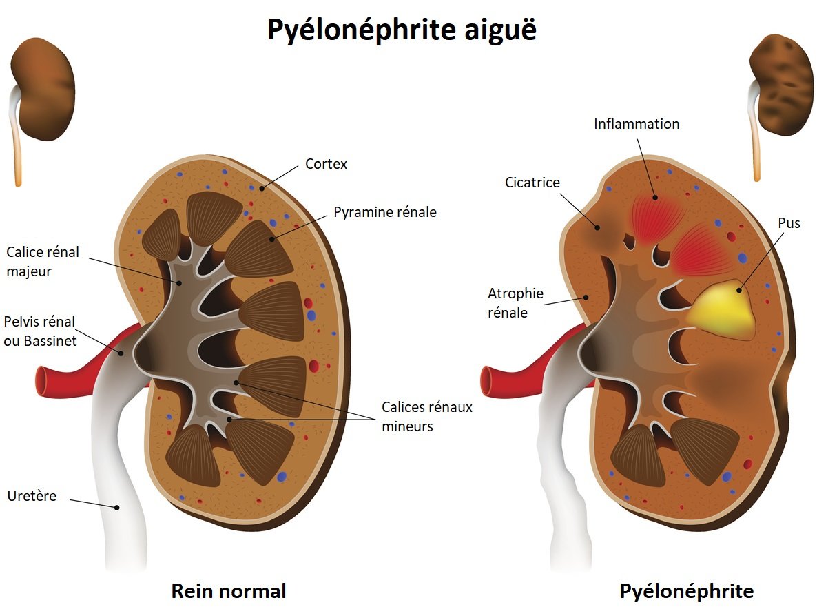 Définition : qu'est-ce qu'une pyélonéphrite?