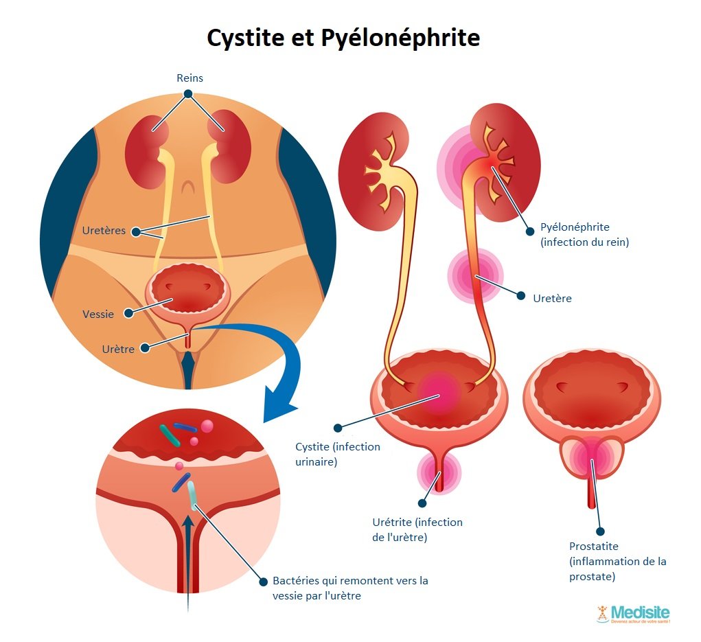 Comment le rein s’infecte-t-il ?