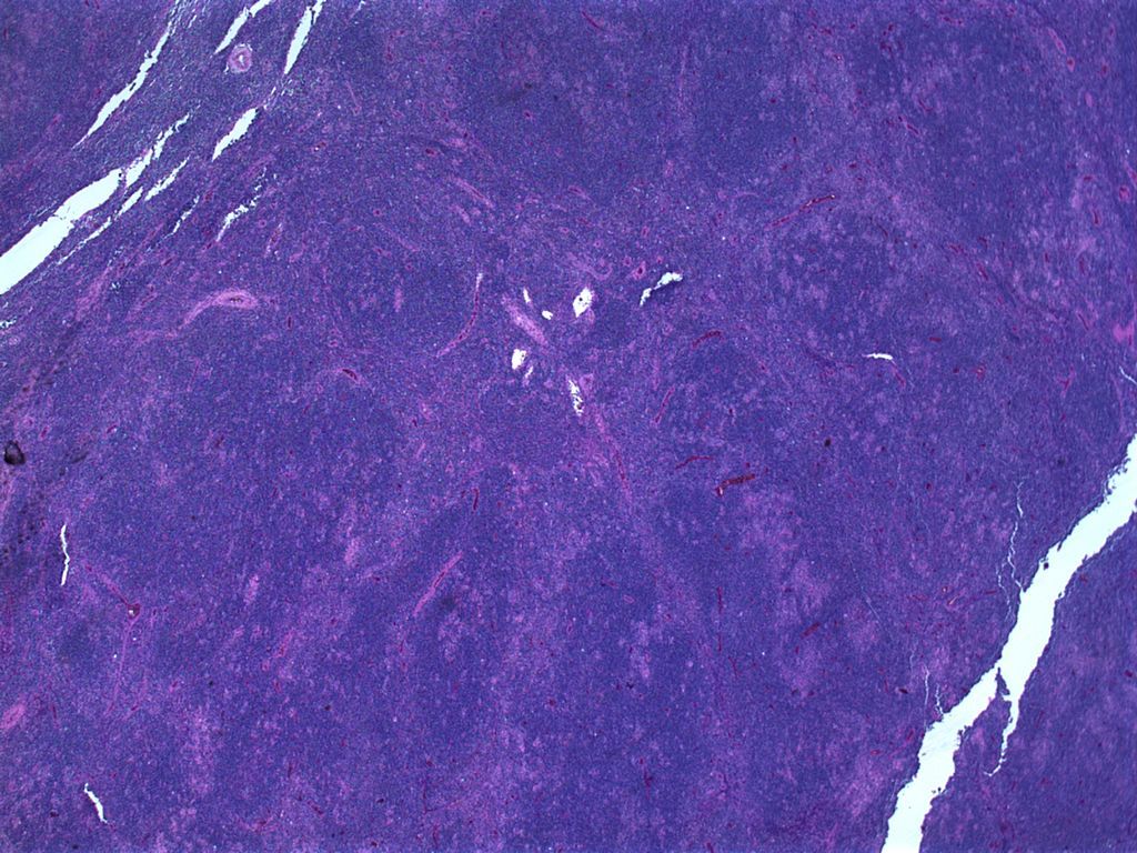 Qu’est-ce que le lymphome du manteau ? 