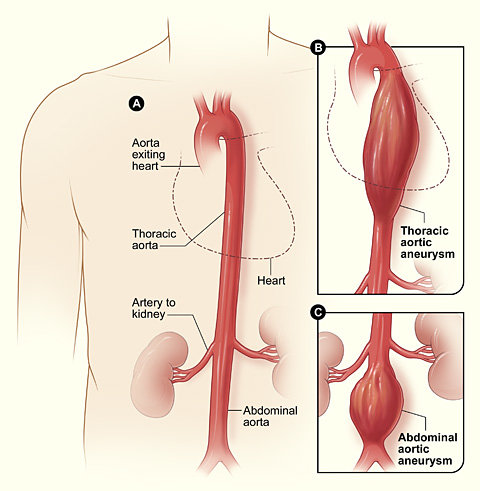 Quels sont les types de ruptures d'anévrisme ?