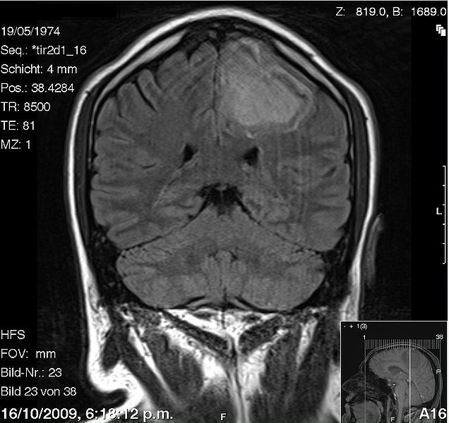 Quelles sont les complications du cavernome cérébral ?