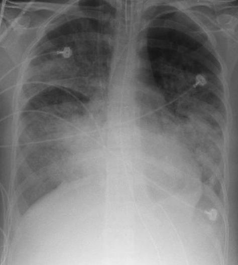Qu'est-ce que le Syndrome de détresse respiratoire aiguë ?