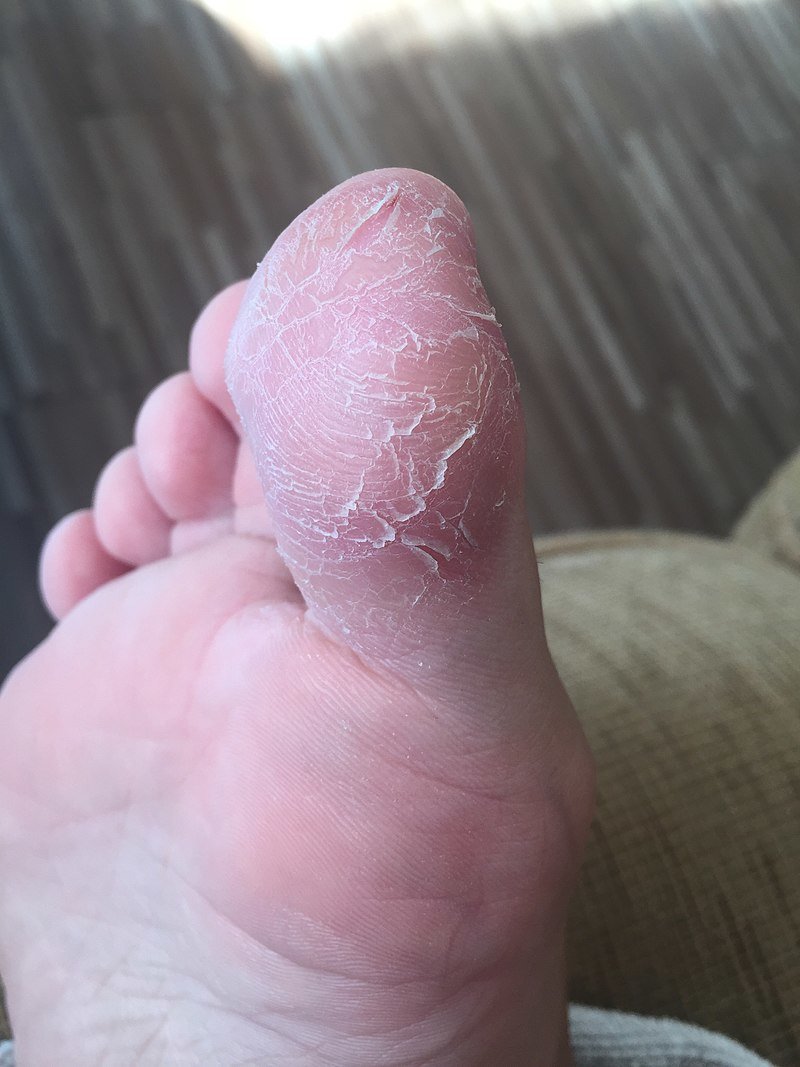 Définition : qu'est-ce que le pied d'athlète ?