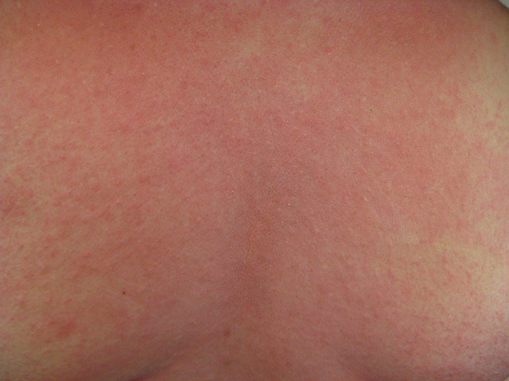 Quels sont les symptômes et signes de cette urgence médicale grave ?