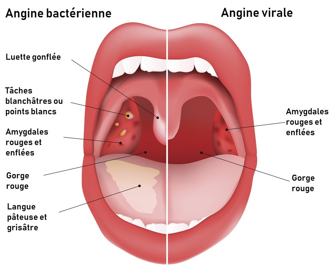 Les symptômes de l'angine